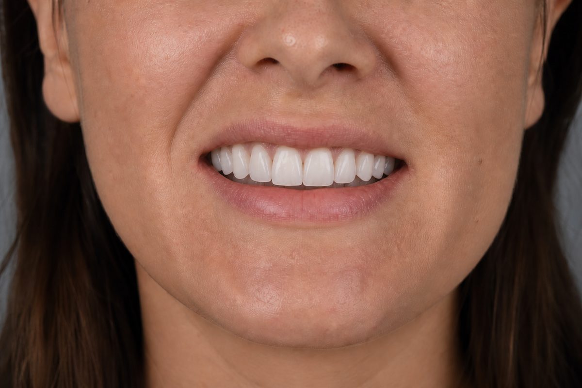 Porcelain veneer smile makeover — After