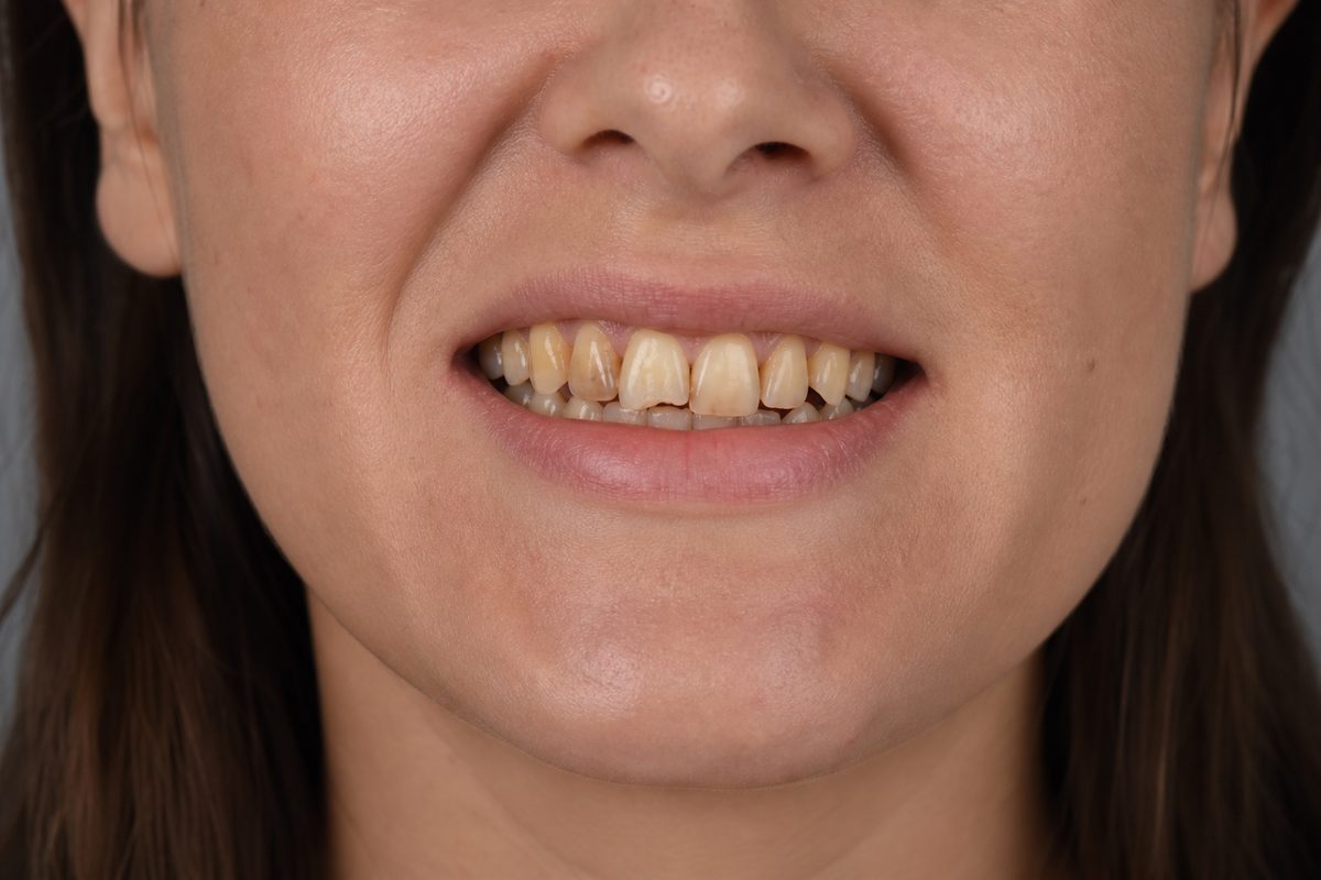 Porcelain veneer smile makeover — Before
