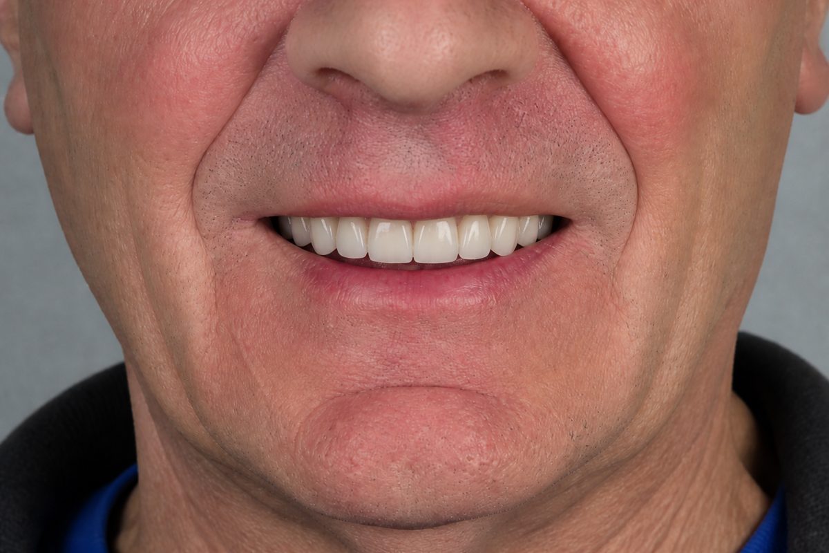 Full-arch confidence rebuild — After