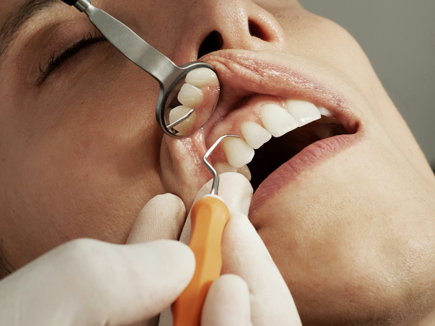 Porcelain veneers
